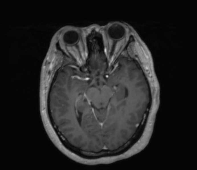 Cerebellopontine angle meningioma (Radiopaedia 35181-36715 Axial T1 C+ 33).jpg