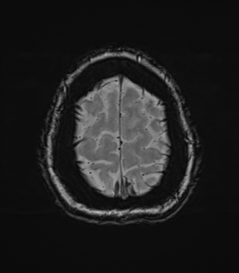 Cerebellopontine angle meningioma (Radiopaedia 48434-53348 Axial SWI 82).png