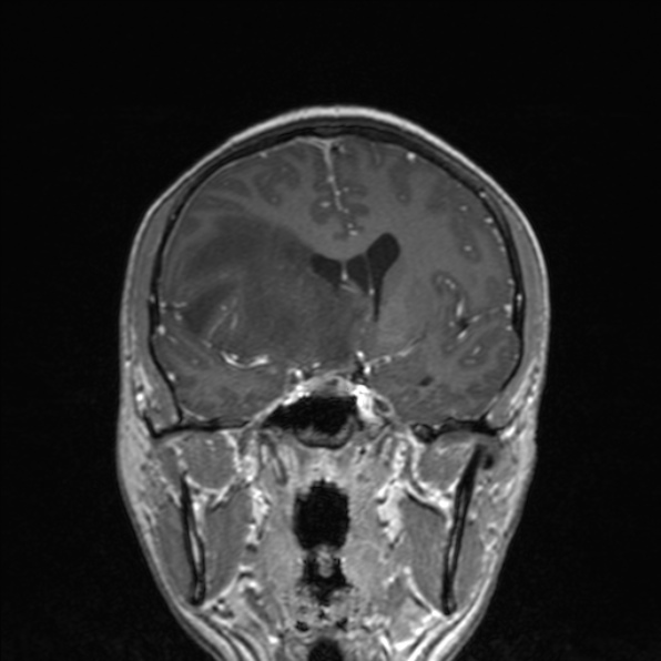 Cerebral abscess (Radiopaedia 24212-24478 Coronal T1 C+ 97).jpg