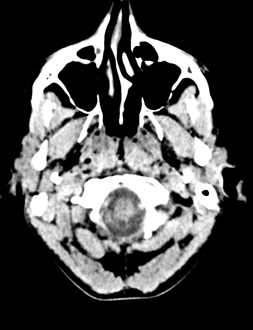 Cerebral abscess (Radiopaedia 60342-68008 Axial non-contrast 5).png