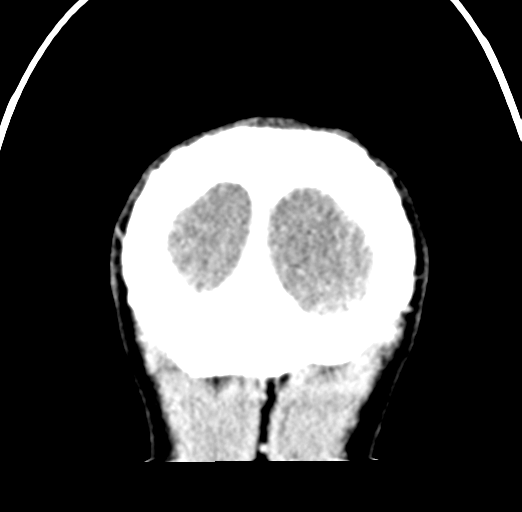 Cerebral abscess (Radiopaedia 60342-68008 Coronal C+ delayed 62).png