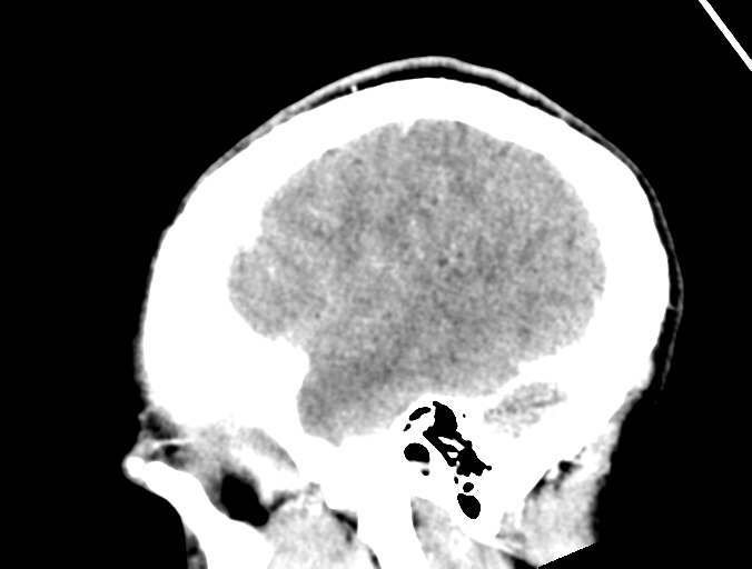 Cerebral abscess (Radiopaedia 60342-68008 Sagittal C+ delayed 9).png