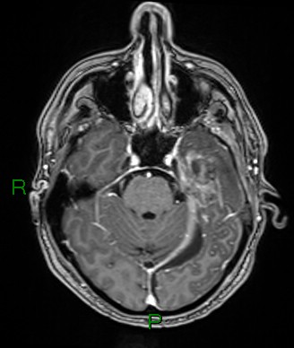 Cerebral abscess and subdural empyema (Radiopaedia 84436-99779 Axial T1 C+ 60).jpg