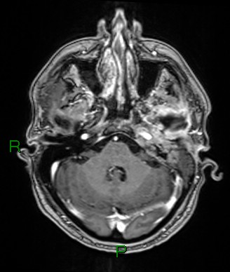File:Cerebral abscess and subdural empyema (Radiopaedia 84436-99779 Axial T1 C+ 66).jpg