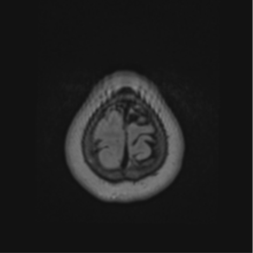 Cerebral abscess from pulmonary arteriovenous malformation (Radiopaedia 86275-102291 J 70).png