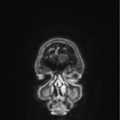 Cerebral abscess from pulmonary arteriovenous malformation (Radiopaedia 86275-102291 L 85).png