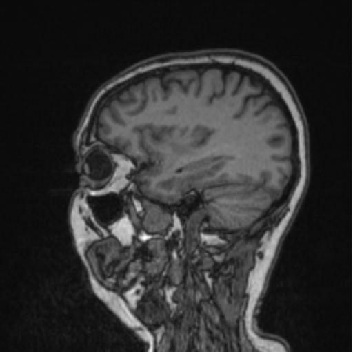 Cerebral abscess from pulmonary arteriovenous malformation (Radiopaedia 86275-102291 Sagittal T1 37).png