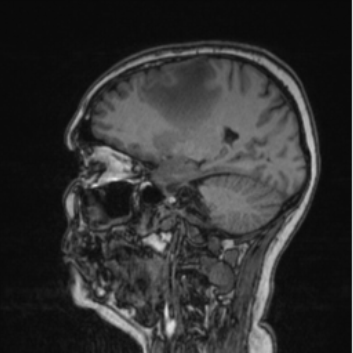Cerebral abscess from pulmonary arteriovenous malformation (Radiopaedia 86275-102291 Sagittal T1 62).png