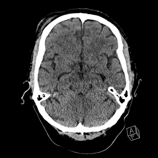 Cerebral abscess with ventriculitis (Radiopaedia 78965-91876 Axial non-contrast 19).jpg