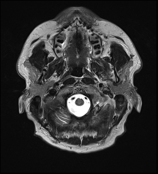 File:Cerebral abscess with ventriculitis (Radiopaedia 78965-91878 Axial T2 4).jpg