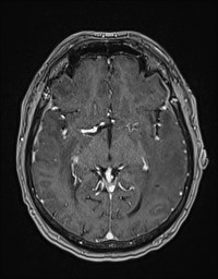 Cerebral amyloid angiopathy-related inflammation (Radiopaedia 58270-65377 Axial T1 C+ fat sat 64).jpg