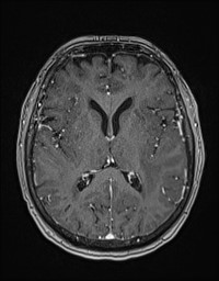 Cerebral amyloid angiopathy-related inflammation (Radiopaedia 58270-65377 Axial T1 C+ fat sat 77).jpg