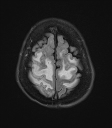 File:Cerebral amyloid angiopathy-related inflammation (Radiopaedia 74836-85849 Axial FLAIR 25).jpg