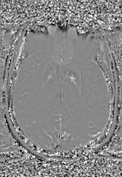 File:Cerebral amyloid angiopathy (Radiopaedia 29129-29518 Axial SWI Phase 19).jpg