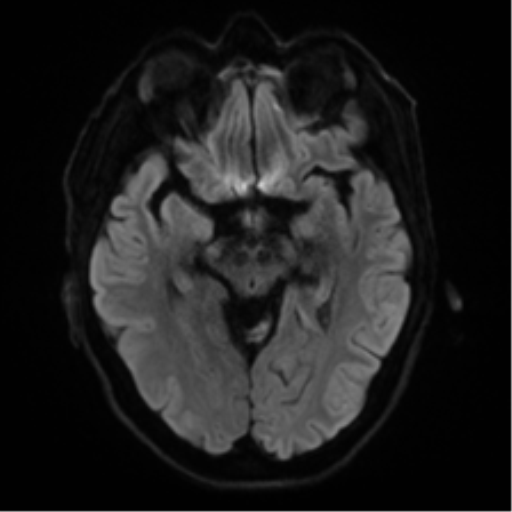 Cerebral amyloid angiopathy (Radiopaedia 46082-50433 Axial DWI 38).png