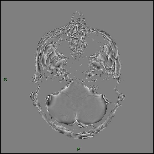 Cerebral amyloid angiopathy (Radiopaedia 77506-89664 H 23).jpg