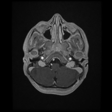 Cerebral and spinal tuberculosis (Radiopaedia 90489-107837 Axial T1 C+ 46).jpg