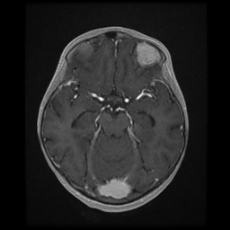 Cerebral and spinal tuberculosis (Radiopaedia 90489-107837 Axial T1 C+ 83).jpg