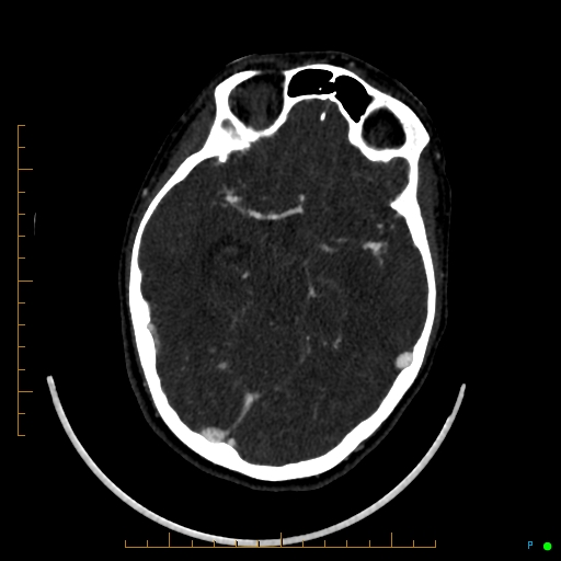 Cerebral arteriovenous malformation (AVM) (Radiopaedia 78162-90706 Axial CTA 119).jpg