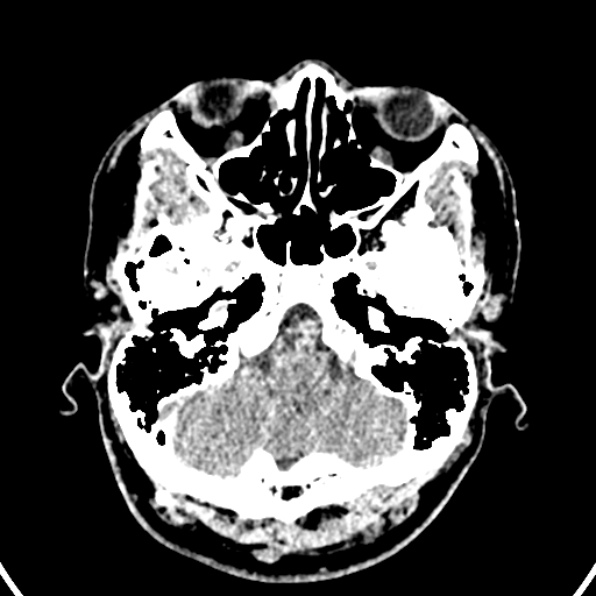 Cerebral arteriovenous malformation (Radiopaedia 37182-39012 Axial non-contrast 7).jpg