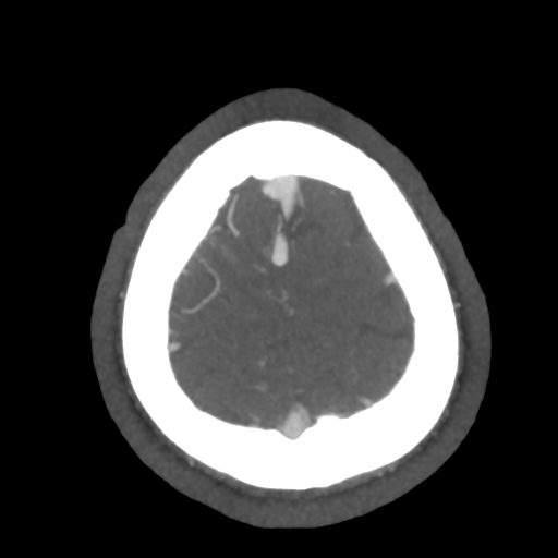 File:Cerebral arteriovenous malformation (Radiopaedia 39259-41505 AX CEREBRAL CTA 52).png