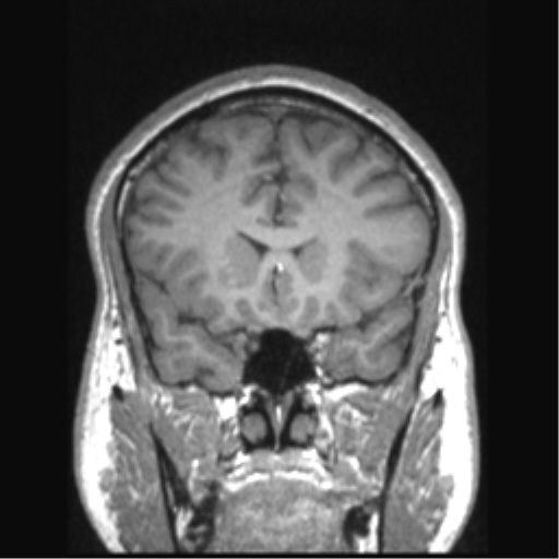 Cerebral arteriovenous malformation (Radiopaedia 39259-41506 Coronal T1 63).png