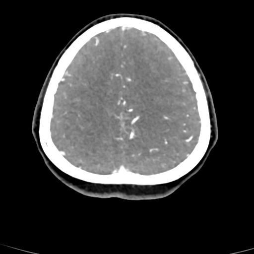 Cerebral arteriovenous malformation (Radiopaedia 73830-84645 B 23).jpg