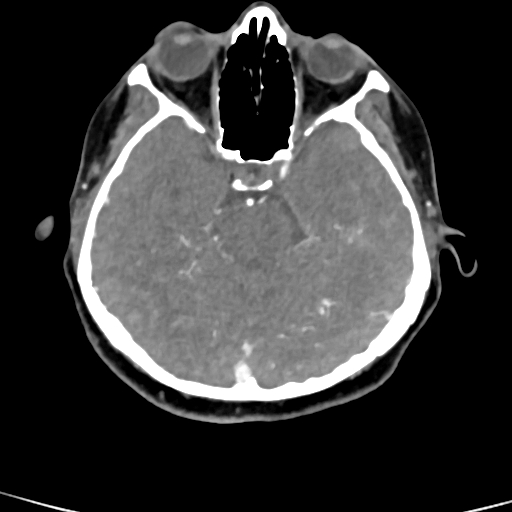Cerebral arteriovenous malformation (Radiopaedia 73830-84645 B 67).jpg