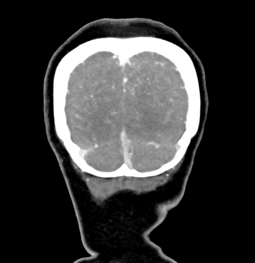 Cerebral arteriovenous malformation (Radiopaedia 73830-84645 C 87).jpg