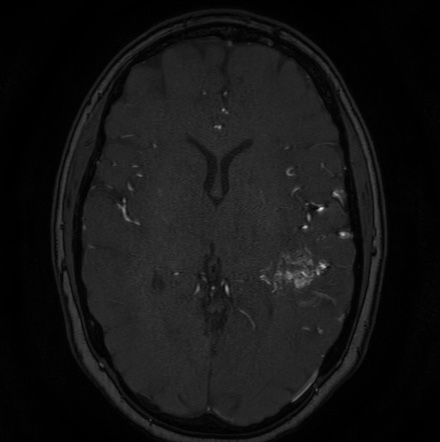 Cerebral arteriovenous malformation (Radiopaedia 74411-85654 Axial MRA 74).jpg