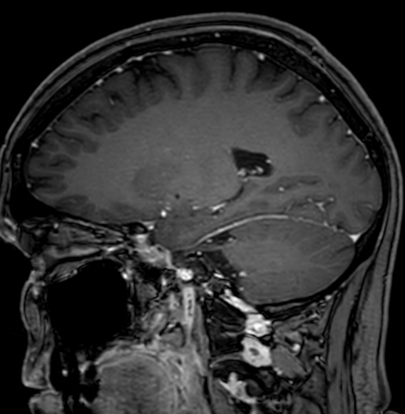 Cerebral arteriovenous malformation (Radiopaedia 74411-85746 Sagittal T1 C+ 46).jpg
