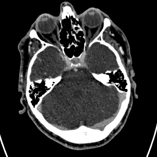 Cerebral arteriovenous malformation (Radiopaedia 78188-90746 Axial C+ delayed 50).jpg