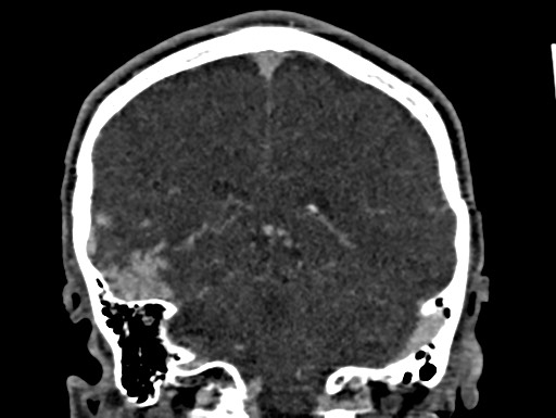 Cerebral arteriovenous malformation (Radiopaedia 78188-90746 Coronal C+ delayed 81).jpg