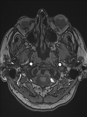 Cerebral arteriovenous malformation (Radiopaedia 84015-99245 Axial TOF 45).jpg
