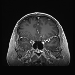 Cerebral arteriovenous malformation (Radiopaedia 84015-99245 Coronal T1 C+ 53).jpg