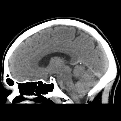 Cerebral arteriovenous malformation (Spetzler-Martin grade 2) (Radiopaedia 41262-44076 A 31).png