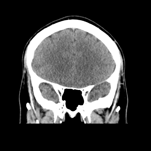 Cerebral arteriovenous malformation (Spetzler-Martin grade 2) (Radiopaedia 41262-44076 Coronal non-contrast 20).png