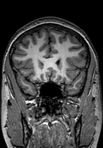 Cerebral arteriovenous malformation at posterior body of corpus callosum (Radiopaedia 74111-84925 Coronal T1 91).jpg