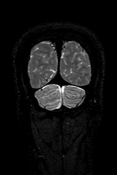 Cerebral arteriovenous malformation at posterior body of corpus callosum (Radiopaedia 74111-84925 Coronal T2 162).jpg