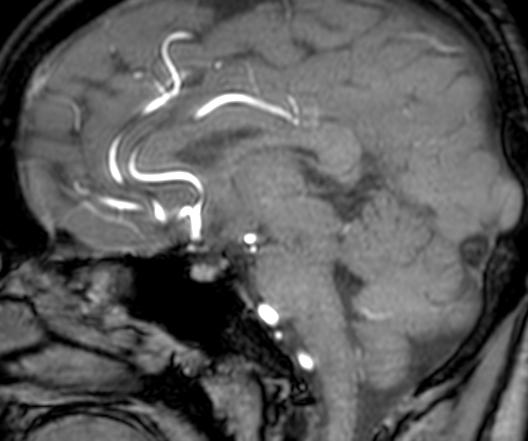 Cerebral arteriovenous malformation at posterior body of corpus callosum (Radiopaedia 74111-84925 J 202).jpg