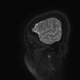 Cerebral arteriovenous malformation at posterior body of corpus callosum (Radiopaedia 74111-84925 Sagittal T2 130).jpg