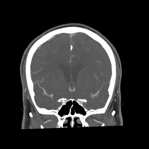 Cerebral arteriovenous malformation with lobar hemorrhage (Radiopaedia 35598-57216 C 37).jpg