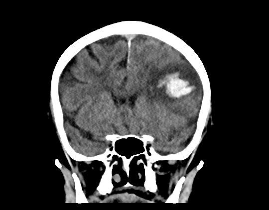 Cerebral arteriovenous malformation with lobar hemorrhage (Radiopaedia 44725-48510 Coronal non-contrast 20).png