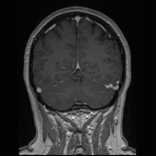 Cerebral cavernoma and development venous anomaly (Radiopaedia 37603-39482 Coronal T1 C+ 27).png