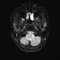 Cerebral cavernous venous malformation (Radiopaedia 70008-80021 Axial DWI 3).jpg