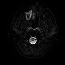 File:Cerebral cavernous venous malformation (Zabramski type II) (Radiopaedia 85511-101198 Axial DWI 69).jpg