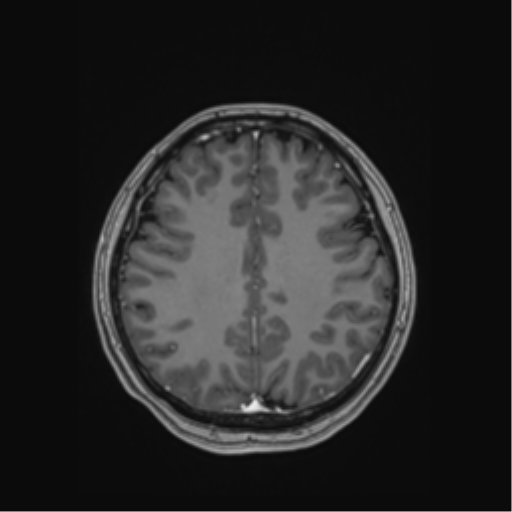 Cerebral cavernous venous malformations (Radiopaedia 48117-52946 Axial T1 C+ 43).png