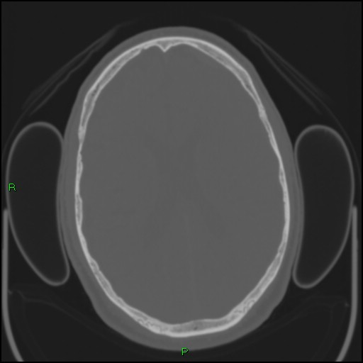 Cerebral contusions (Radiopaedia 33868-35039 Axial bone window 128).jpg