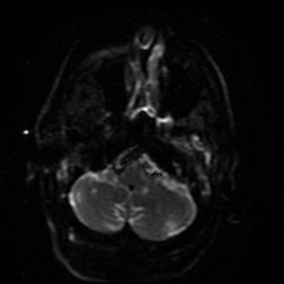 Cerebral embolic infarcts (embolic shower) (Radiopaedia 49837-55108 Axial DWI 40).jpg