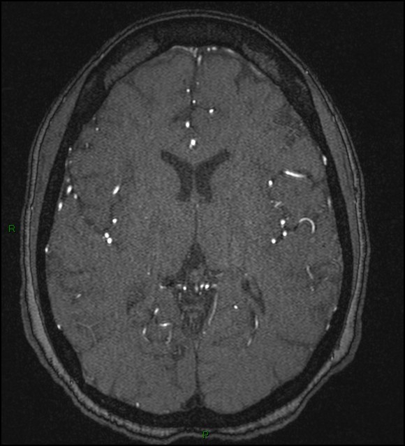 Cerebral fat embolism (Radiopaedia 35022-36525 Axial TOF 113).jpg